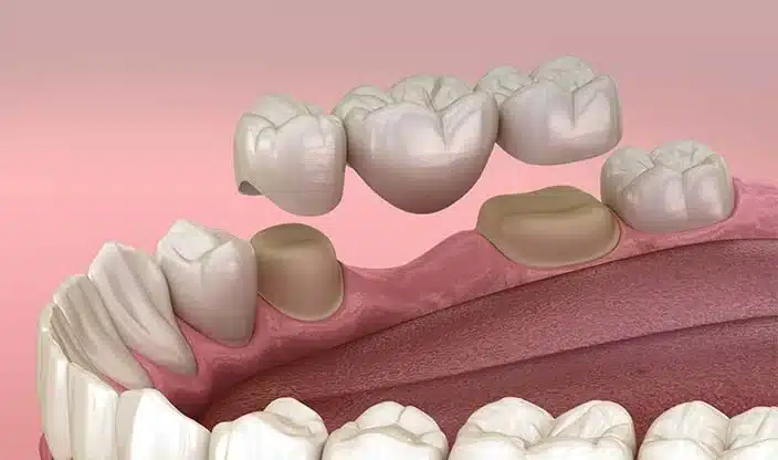 Dental Bridge